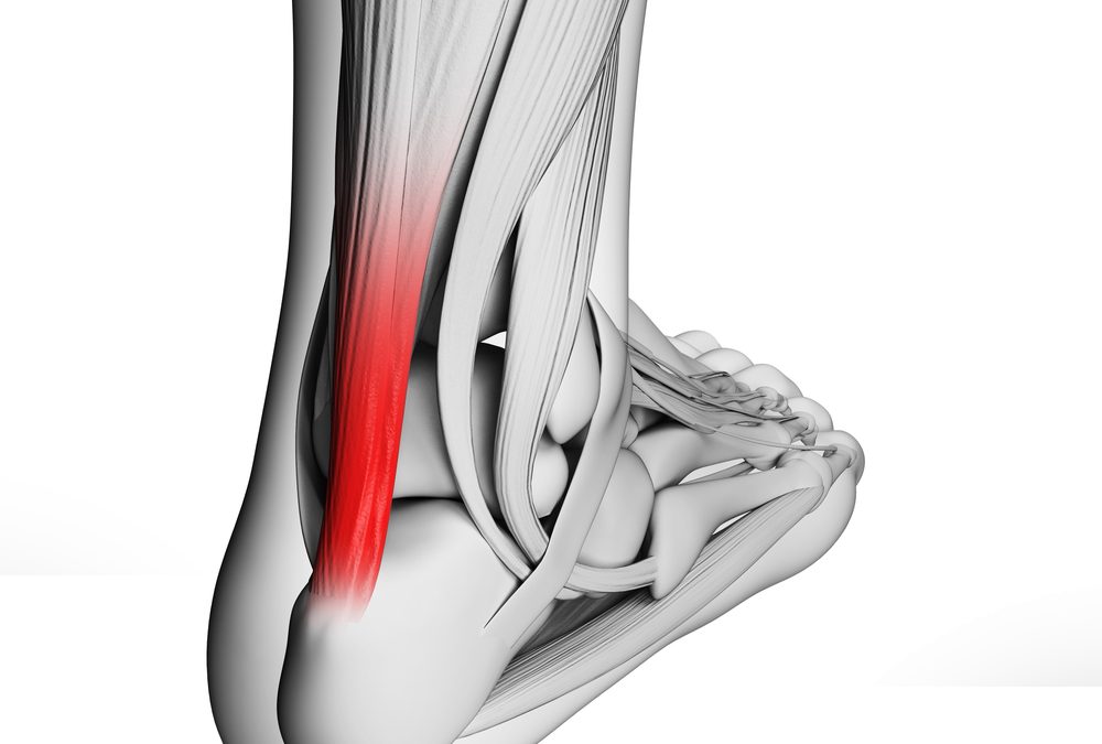 How Can Achilles Tendonitis Be Prevented