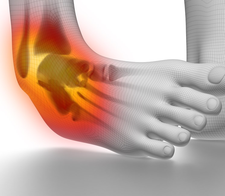 Ankle Sprain and Pain