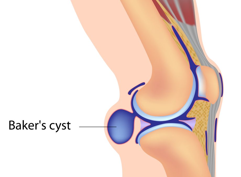 Baker’s Cyst