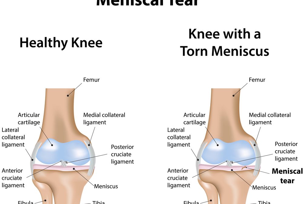 Meniscus Tear