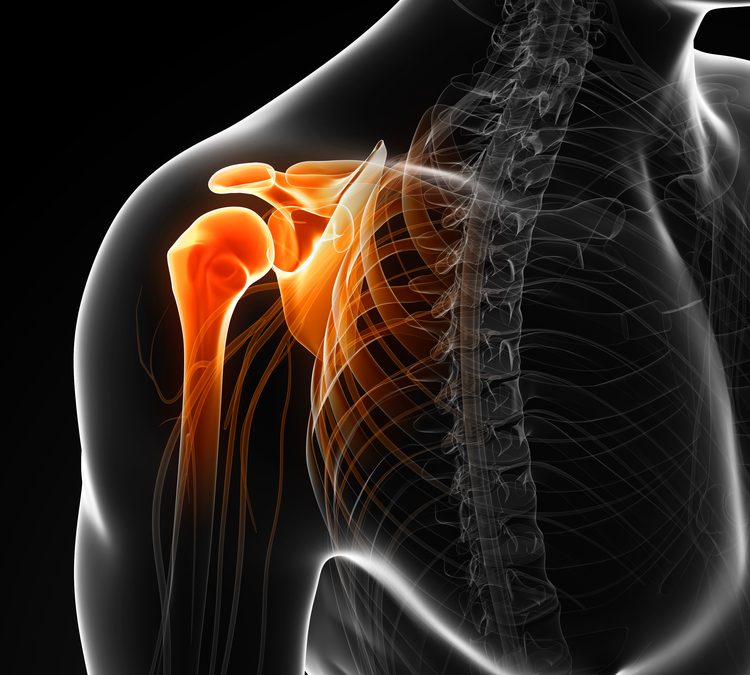 Shoulder Pain Due to Rotator Cuff Problems