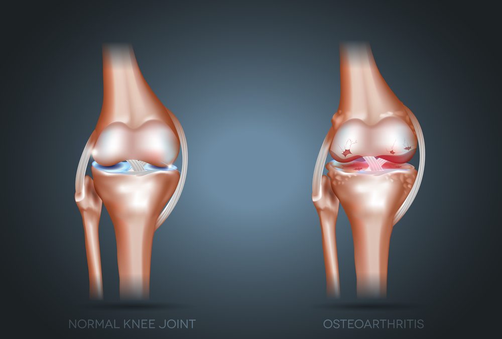 Keeping Active with Osteoarthritis